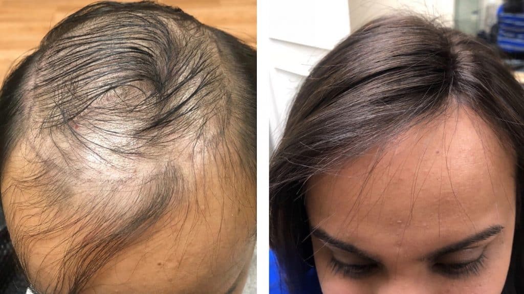 Non surgical hair system Clearance