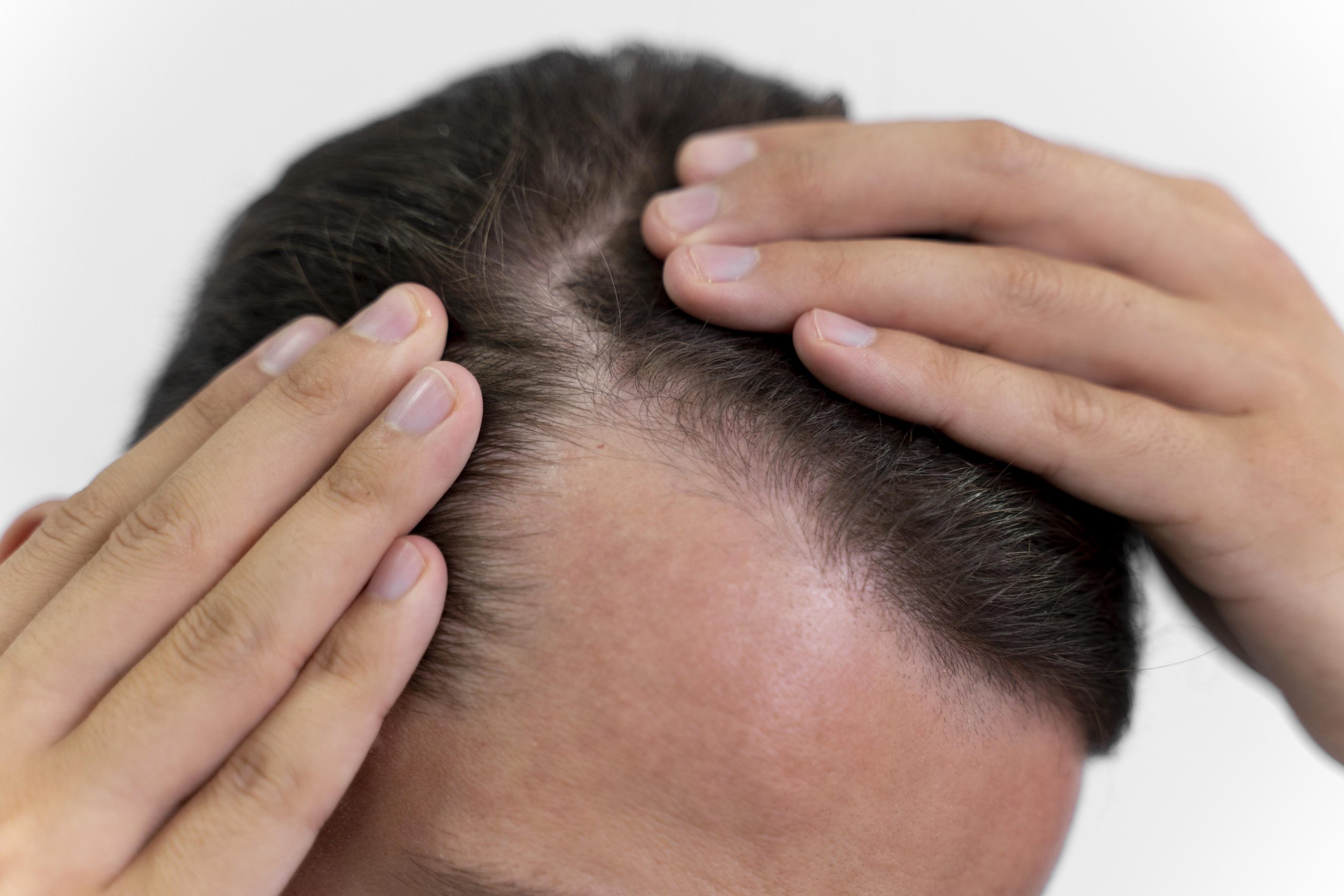 Hair Loss Problems | Guci Image